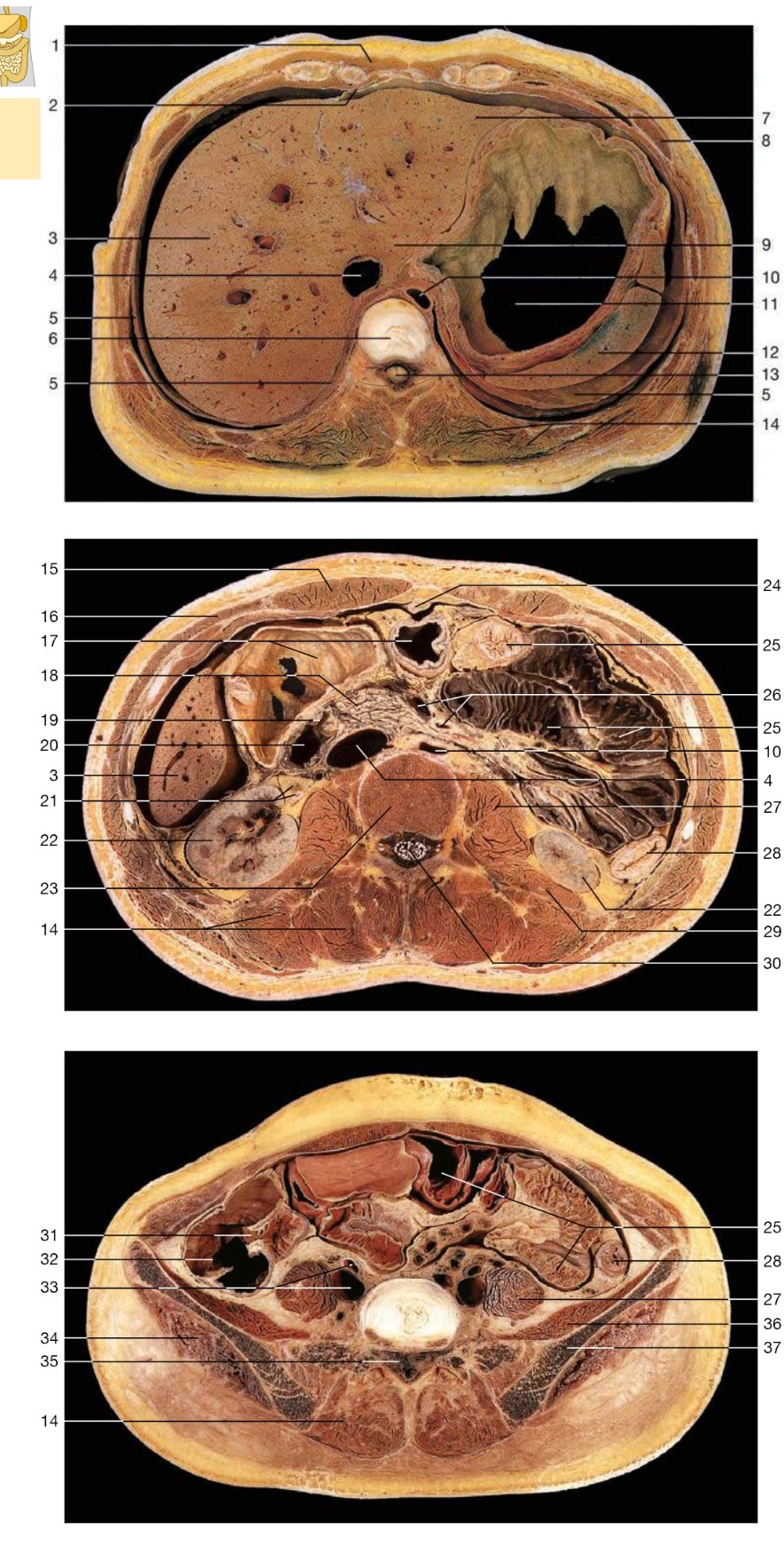 <p>Rectus abdominus muscle</p>