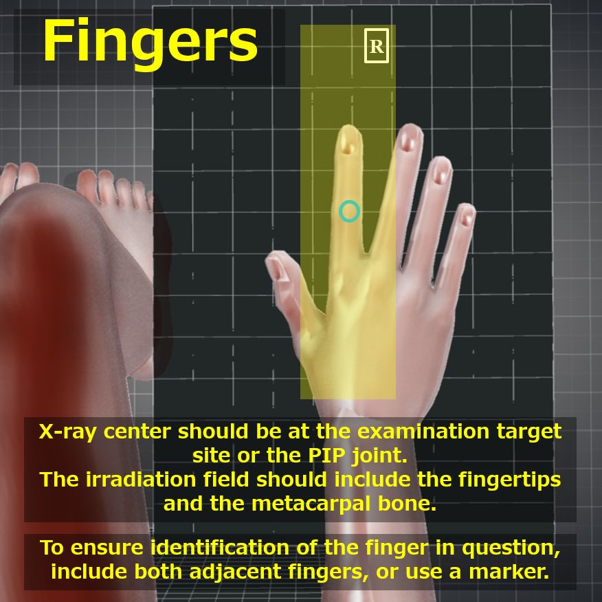 <p>position: patient seated, elbow flexed 90. pronate hand and separate fingers.</p><p></p><p>IR: portrait (collimate to area of interest on four sides while including distal aspect of metacarpal)</p><p></p><p>breathing instructions: hold still</p><p></p><p>technique: 55-65, 1-3</p><p></p><p>SID: 40</p><p></p><p>CR: PIP joint</p><p></p><p>marker: correct marker on side that is more lateral</p>