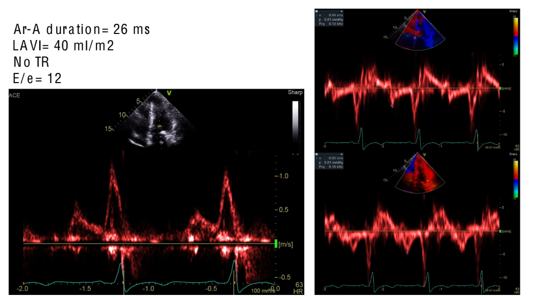 <p>Grade the diastology you see here</p>