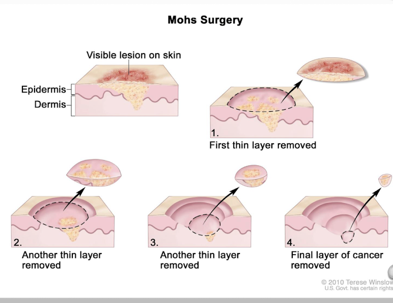 <p>layers of the tissue are shaved away and placed under a microscope</p><p>shaving continues until there id no longer presence of the lesion </p>