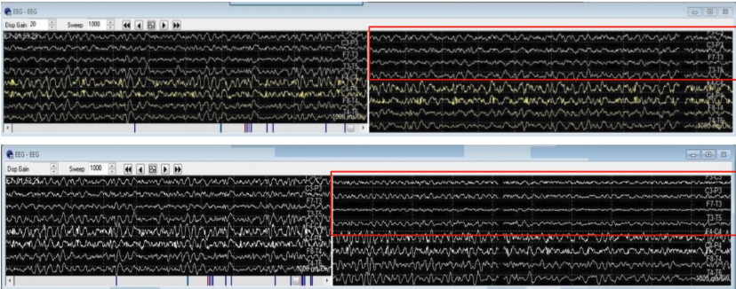 <p>When the anticoagulant heparin is administered and we take our baseline, the EEG looks stable and symmetric (first picture). Is this true for when the clamp was added (second picture)? The surgery is taking place on the left CEA. </p>