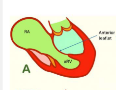 <ul><li><p>Mild apical displacement of the septal and posterior leaflets</p></li><li><p>Small atrialized RV</p></li><li><p>Adequate functional RV function</p></li></ul><p></p>