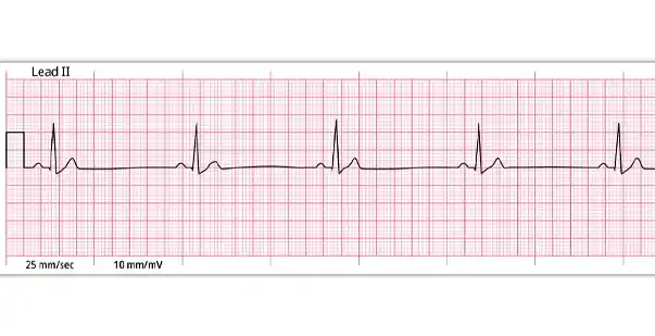 <p>What type of rhythm is this?</p>