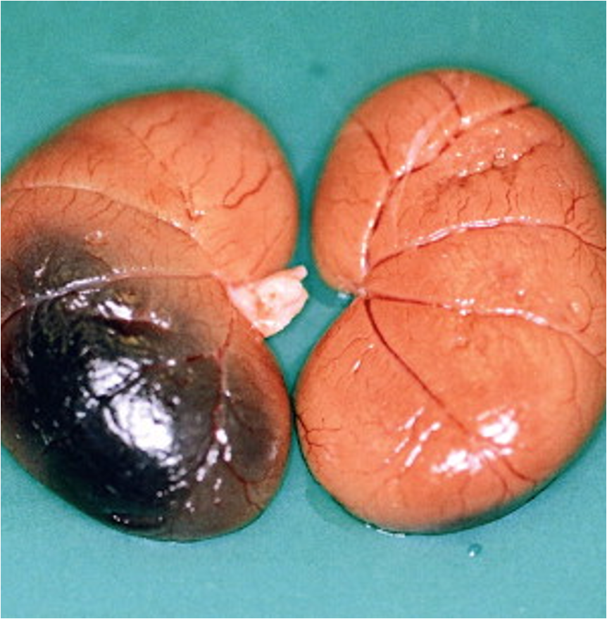 <p>What does this refer to</p><ul><li><p>High speed vertical or horizontal deceleration trauma</p><ul><li><p>Duodenal injuries</p></li></ul></li><li><p>Injuries range in severity</p><ul><li><p>Intramural hematoma</p></li><li><p>Extensive crush or laceration</p></li></ul></li><li><p>Presentation includes</p><ul><li><p>Abdominal pain</p></li><li><p>Fever</p></li><li><p>Nausea</p></li><li><p>Vomiting</p></li></ul></li></ul><p></p>