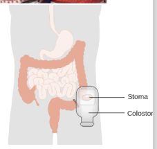 <ul><li><p><span>Opening from the colon</span></p></li><li><p><span>Located LIF (not always)</span></p></li><li><p><span>Solid, faecal content (depending on length of colon)</span></p></li><li><p><span>Protrudes 10mm, more flushed to skin. Firm and well formed</span></p></li><li><p><span>Descending, transverse or ascending - indicates where it is on the body</span></p></li><li><p><span>End-colostomy (temporary or permanent)</span></p></li><li><p><span>Loop colostomy</span></p></li></ul><p></p>