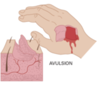 <p>A wound where skin or tissue is torn away (partially or completely)</p>