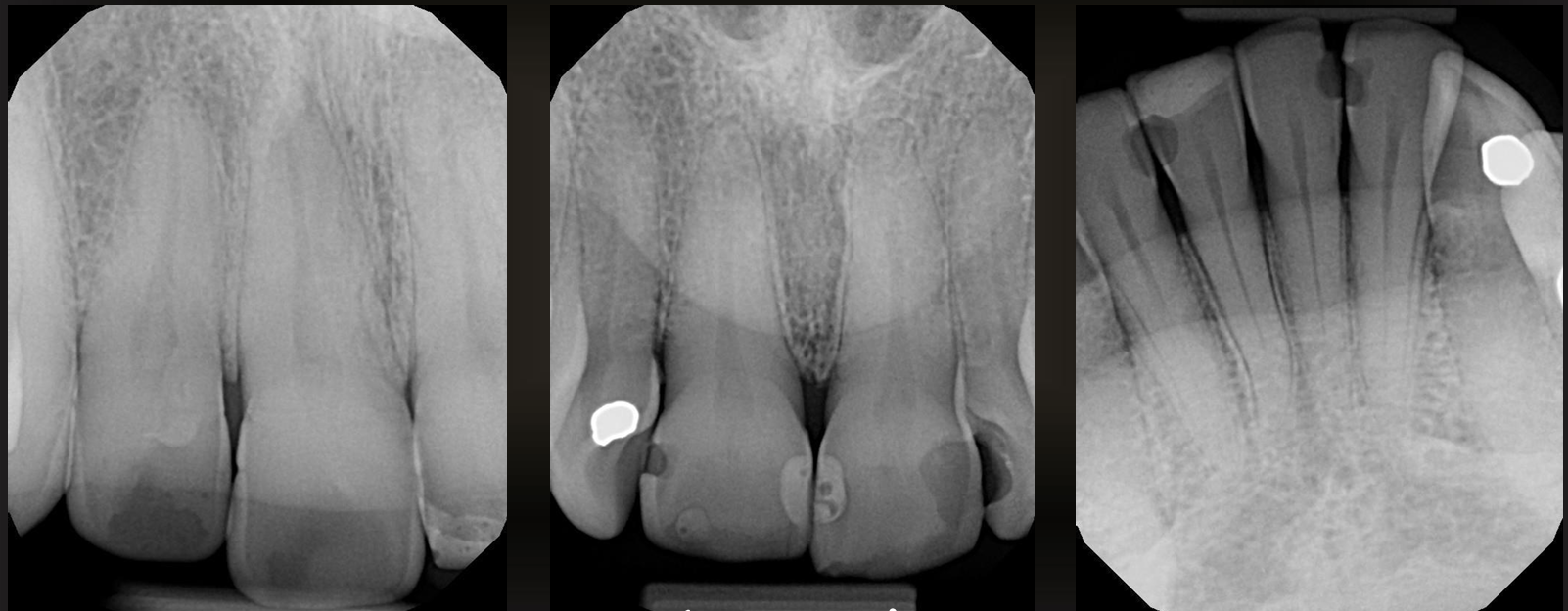 <p>are these caries or restorations with radiolucent materials?</p>