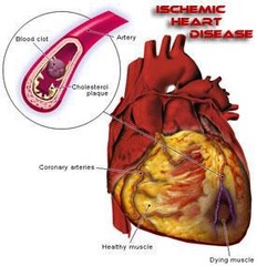 <p>It leads to fixed coronary artery narrowing, contributing to angina.</p>