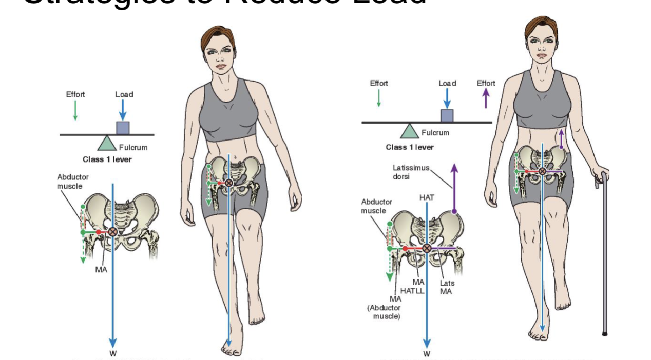 <p><strong>Having bag in left hand   </strong></p><ul><li><p>work harder working on left hand b/c increase external moment size</p></li><li><p>right hand magnitude of force increases but external moment arm is brought closer to hip joint axis</p></li><li><p>need less hip abductor forces </p></li></ul><p></p><p></p><p><strong>Cane = helps w/ BoS and balance out frontal plane moments</strong></p><ul><li><p>pushing down on cane uses lateral trunk muscles that elevate pelvis </p></li><li><p>if left side hurts, want cane to be in right hand </p><ul><li><p>b/c if in left single limb stance, you have increased BoS and if you are contracting lateral trunk muscles that attach to your pelvis and can lift it. —> you want to lift right side </p></li></ul></li></ul><p></p><p></p><p><strong>For someone withn osteoarthritis</strong></p><ul><li><p>when having problem w/ right leg put bag on shoulder of Right leg</p><ul><li><p>this allows for bringing mass closer to axis of rotation, requiring stronger (left) side to work more </p></li></ul></li></ul><p></p><p></p>