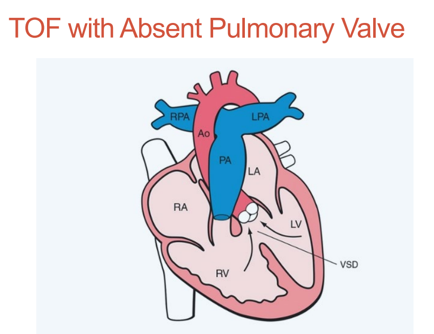 <p>Massively dilated PA and PA branches •</p><p>To and fro pattern in rudimentary PV •</p><p>Overriding Aorta •</p><p>Malalignment VSD</p><p></p><p>A rudimentary pulmonary valve is <strong><mark data-color="rgba(0, 0, 0, 0)" style="background-color: rgba(0, 0, 0, 0); color: inherit;">a severely underdeveloped, malformed, or vestigial valve in the heart that fails to function properly</mark></strong></p>