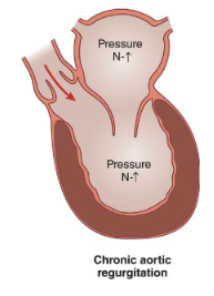 <p>What happens in chronic aortic regurgitation? </p>