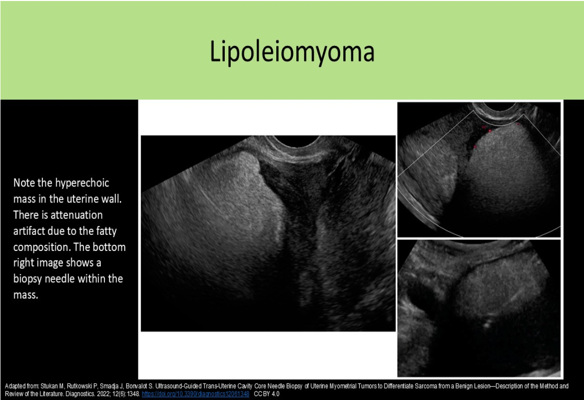 <p>B. fatty tissue</p><p>Lipoleiomyomas form due to degeneration of smooth muscle cells in a leiomyoma. The symptoms are similar to leiomyomas of the same size and location. Sonographic findings include: Hyperechoic fatty mass with a partially hypochoic muscular rim, Posterior acoustic attenuation</p>