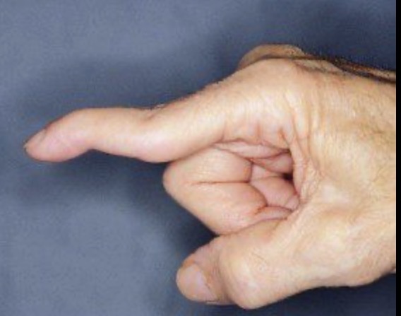 <p>Associated with rheumatoid arthritis </p>