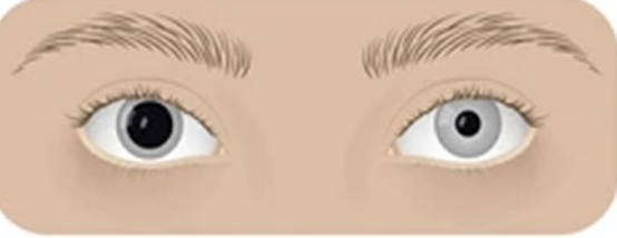 <p>unequal pupils</p>