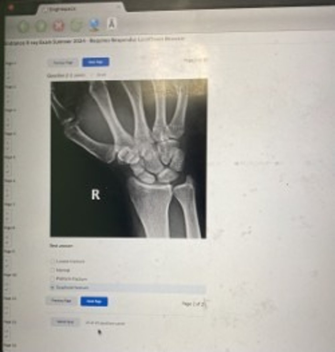 <p>Scaphoid fracture</p>