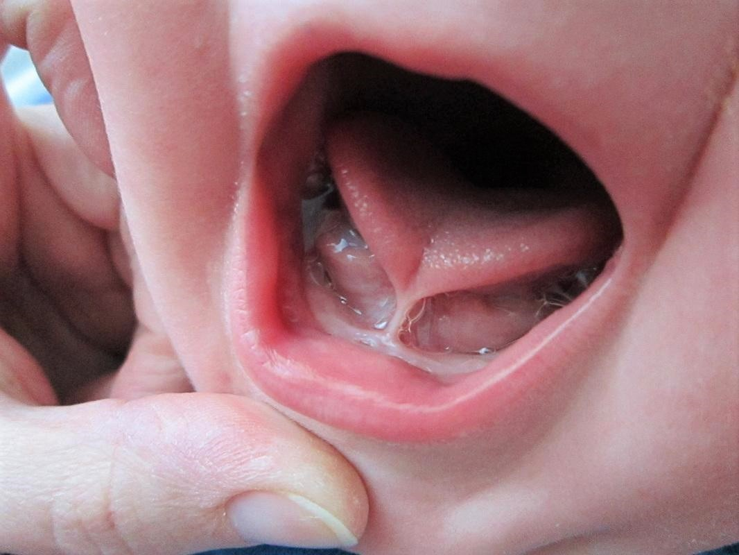 <p>lengua que se queda unida al suelo por frenillo corto </p>