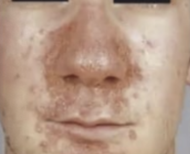 <p>Paciente masculino de 32 años recientemente diagnosticado con VIH. Aun no inicia tratamiento antirretroviral. Acude a consulta por referir que desde hace 1 mes presenta lesiones eritemato escamosas en la región facial, pruriginosas, que descaman y nota que se ha llegado a infectar por el rascado. Últimamente aparecen lesiones también en extremidades ¿Cuál es el diagnóstico más probable?</p>