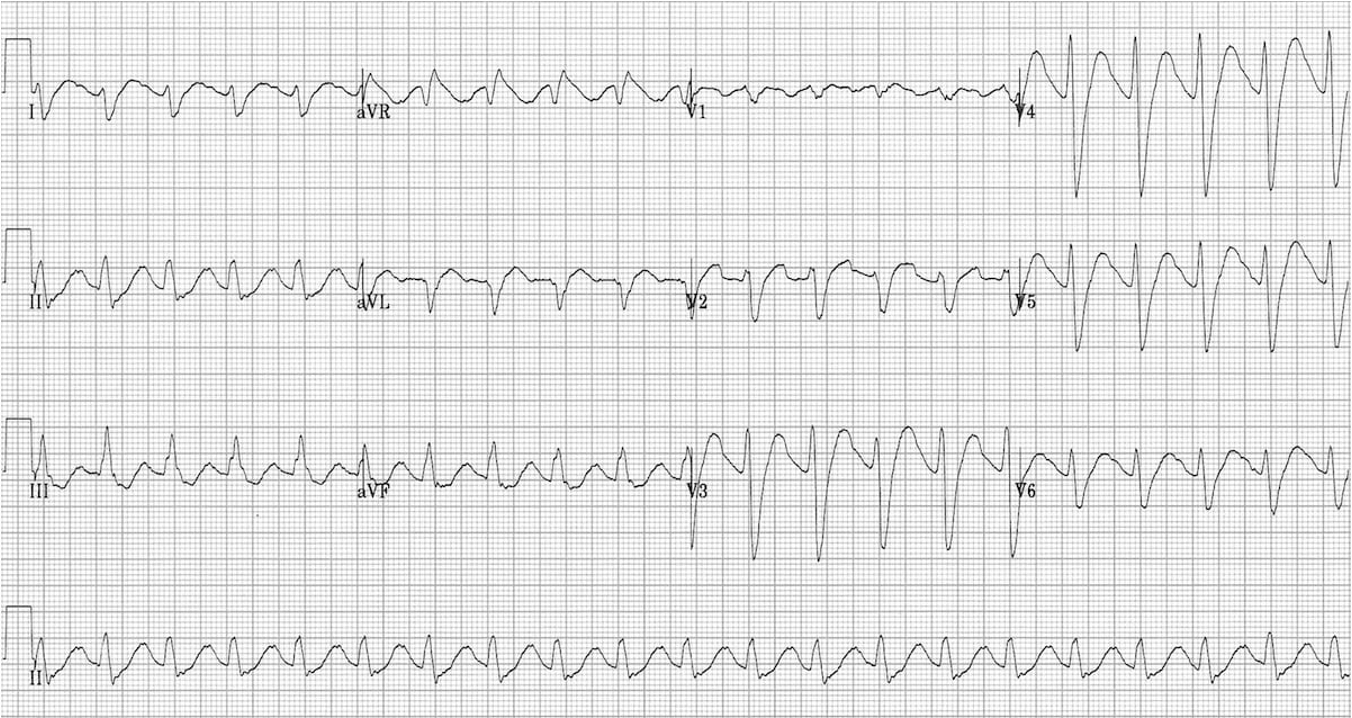 <ul><li><p>Sinus tachycardia </p></li><li><p>Rightward axis </p></li><li><p>Prolonged PR and QT</p></li><li><p>Widened QRS → worsens as toxicity increases </p></li><li><p>Terminal R wave (right bundle affected > left bundle)</p></li></ul><p></p>