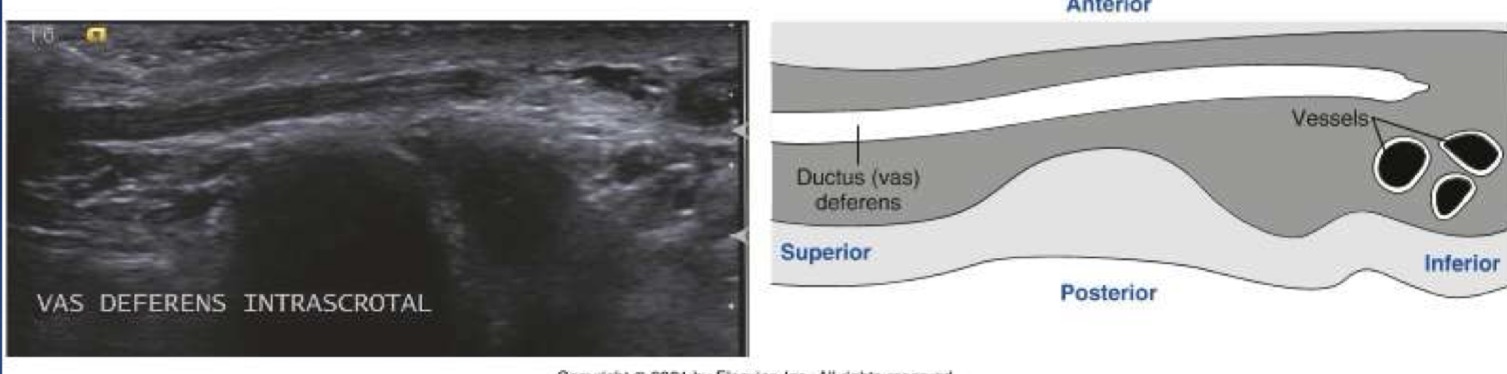 <p>thicker, less convoluted continuation of the ductus epididymis; three smooth muscle layers contribute to this duct’s increased thickness; runs in the spermatic cord through scrotum and inguinal canal; unites with seminal vesicle posterior to bladder to form ejaculatory duct; at terminal portion near seminal vesicles, the ductus deferens dilates; divided into four segments:</p><ul><li><p>Scrotal – inferior</p></li><li><p>Suprascrotal – spermatic cord</p></li><li><p>Prepubic – inguinal region</p></li><li><p>Pelvic – posterior urinary bladder</p></li></ul><p>Normal Measurements: 45cm length</p>
