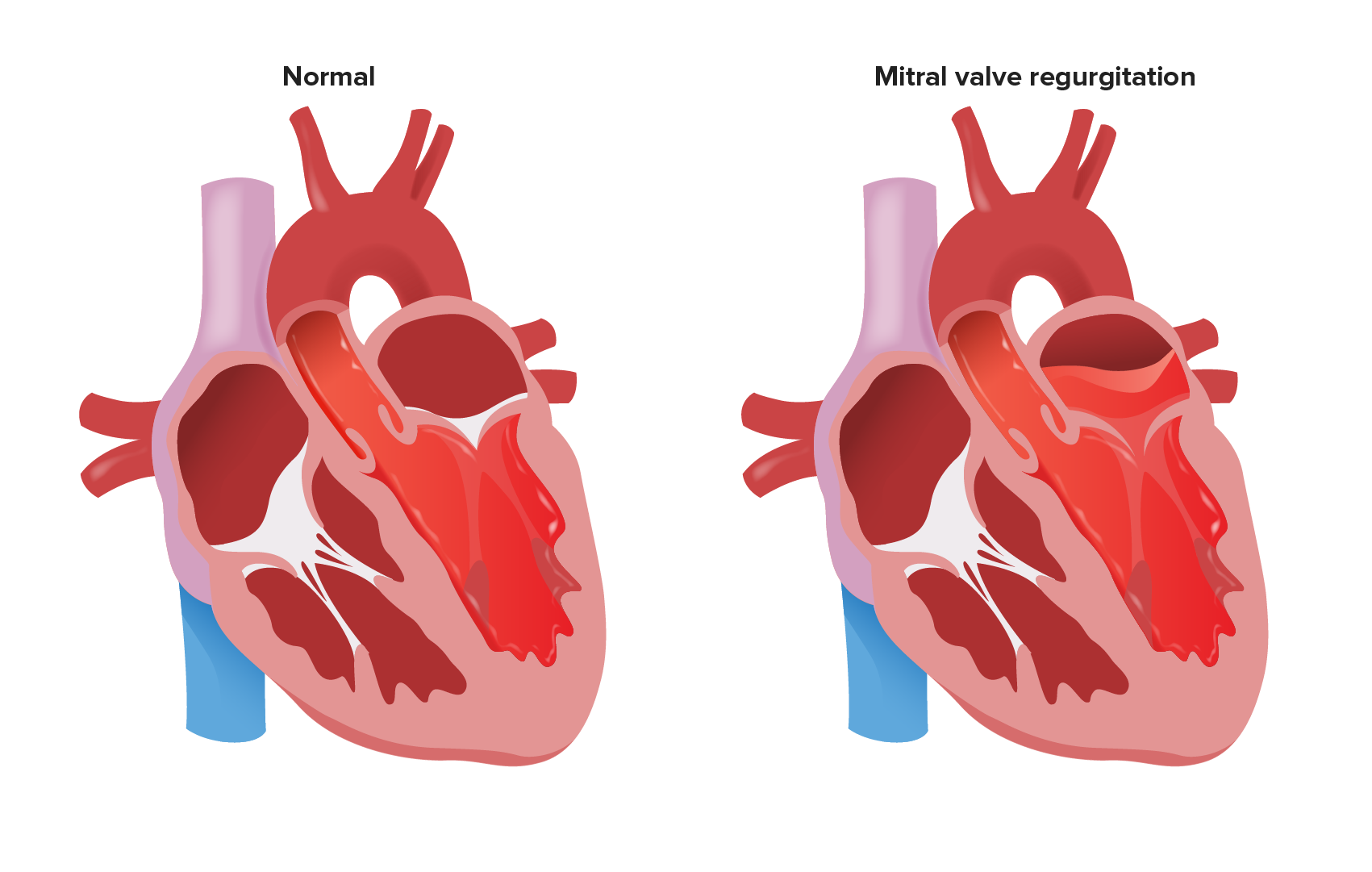 <p><strong>Fibrotic &amp; calcific changes prevent the mitral valve from closing completely during systole…</strong></p><p>i.) Blood flows backward from L ventricle to L atrium (<em>systole</em>)</p><p>ii.) Regurgitant blood flows back to L ventricle along w/ normal flow (<em>diastole</em>) <span>→ higher volume must ejected during next systole </span></p><p><span>iii.) L atrium &amp; L ventricle dilate/hypertrophy to compensate for ↑ volume/pressure</span></p><p><span>iv.) Commonly caused by mitral valve prolapse, rheumatic heart disease, &amp; MI</span></p>