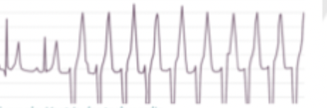 <p>What rhythm is shown?</p>