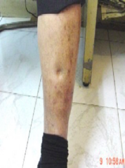 <p>- Mild</p><p>- Pedal edema: elderly, lengthy sitting, non-acclimated.</p><p>- Temperature: normal</p><p>- BP: normal</p><p>- CNS: normal</p><p>- Sweat: +</p><p>- Heart rate: Normal</p>