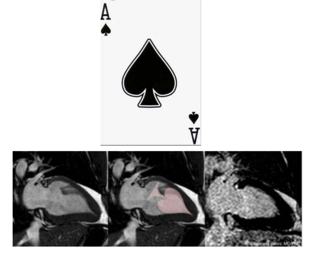<p>Apical HCM has <strong>hypertrophy of the apical segments</strong>, creating an <strong>“ace-of-spades” cavity</strong>.</p>