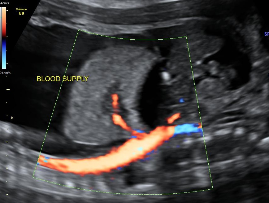 <p>Vascularity of the independent blood supply from pulmonary sequestration </p>