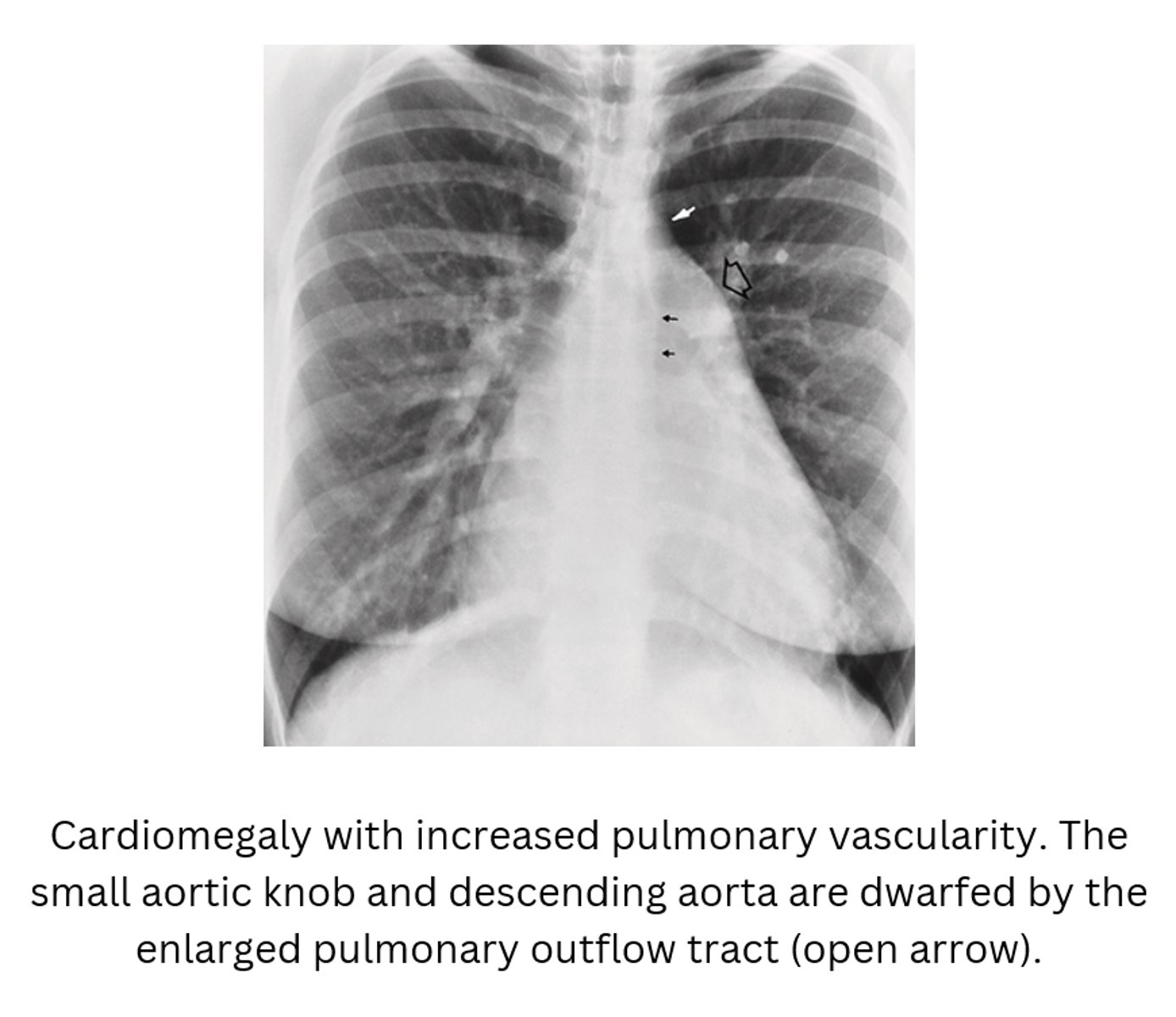 <p>D. CHD atrial septal defect</p>