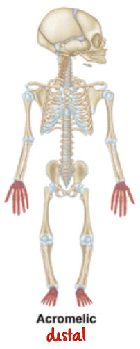 <p>shortening of <span style="color: yellow;">distal</span> segment (hands/feet)</p>