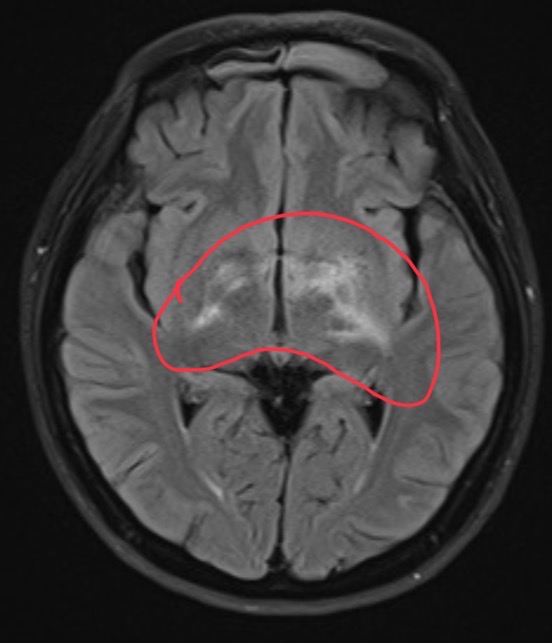 <p>55 year-old female developed patchy vision with white specks seen bilaterally for a few weeks. Currently reports loss of vision in both eyes. There is hyper intensity around the bilateral hypothalamus, left globes pallidus, left post internal capsule, b/l optic tracts, left incision, right midbrain.</p>