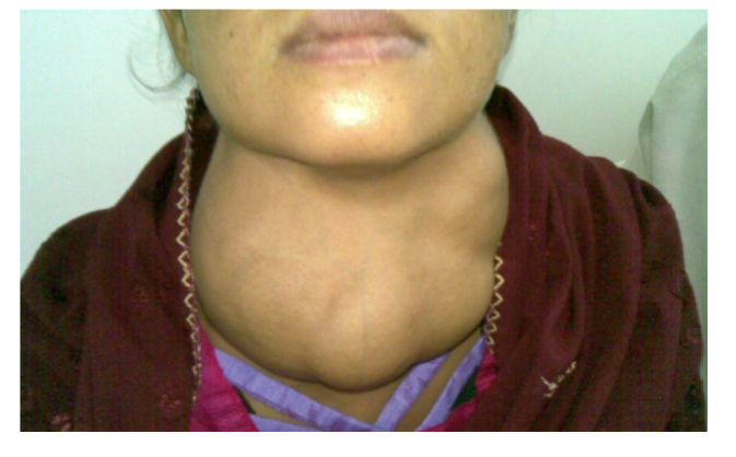 <p>A hormone that stimulates the secretion of another hormone </p><p>ex. Thyroid-stimulating hormone is released from the anterior pituitary, then travels to the blood to stimulate the thyroid gland to release thyroid hormones </p><ul><li><p>Overstimulation can lead to the enlargement of glands ( goiter) </p></li></ul><p></p>
