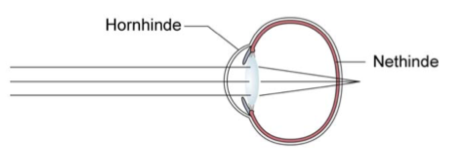 <p><strong>Langsynethed</strong>, hvor øjet enten er <strong>for kort</strong>, eller brydningen er <strong>for svag</strong>, så billedet i det ikke-akkommoderende øje dannes <strong>bag retina</strong>.</p>
