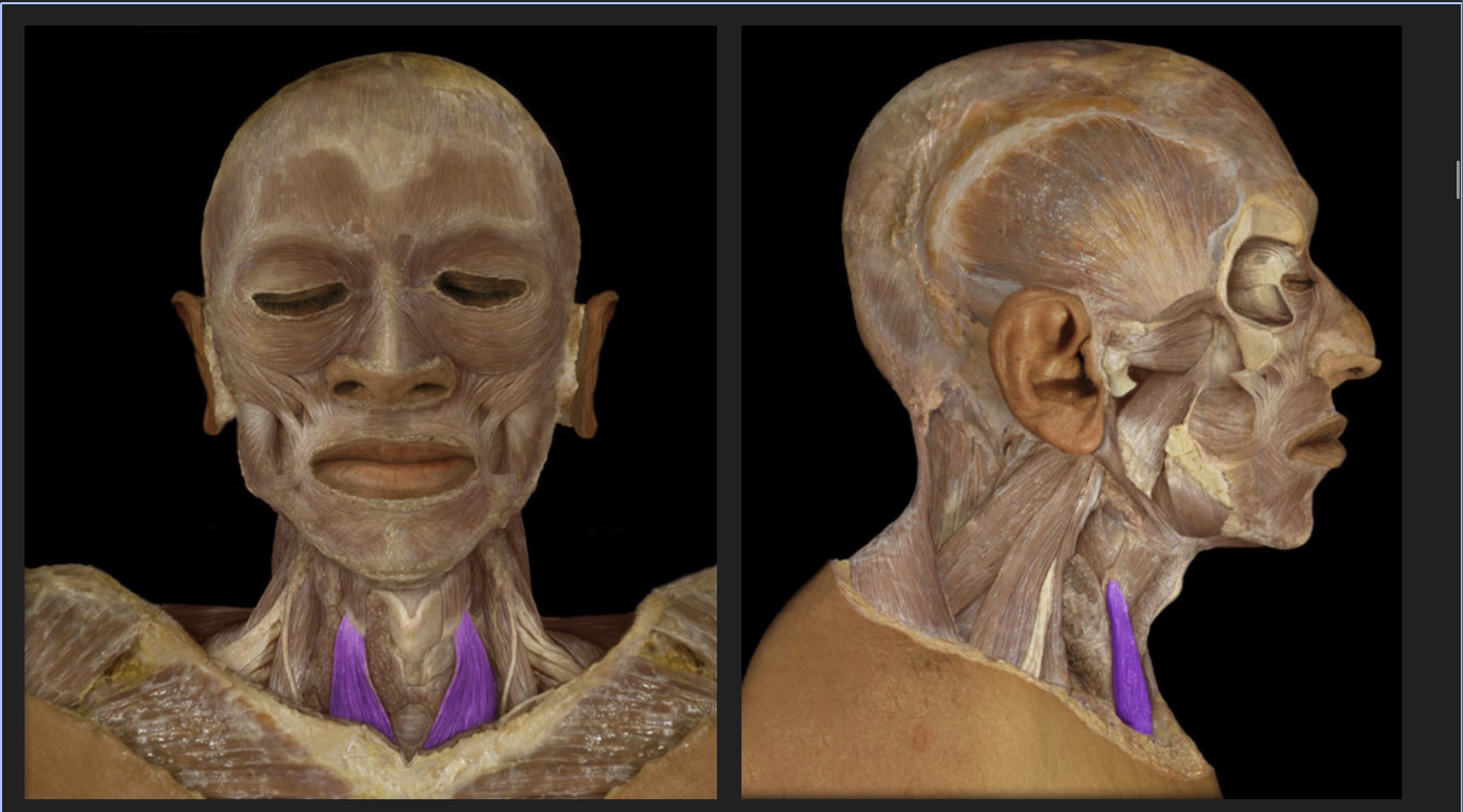 <p>Strap muscle that helps depress the hyoid bone</p>