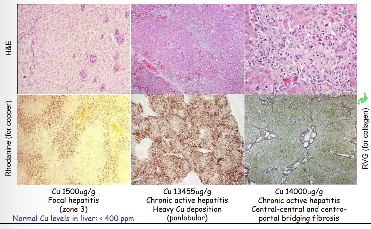<p>Familial copper toxicosis - histo (rhodanine stain)</p>