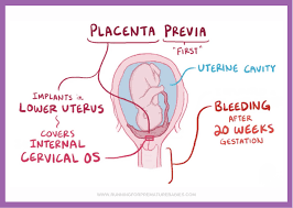 <ul><li><p><strong>definition</strong>: a condition in which the placenta develops over and covers the cervix </p></li><li><p><strong>signs/symptoms</strong>: bright red, painless vaginal bleeding </p></li></ul><p></p>