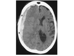 <p>Between dura mater and arachnoid mater.</p><p>Typically crescent-shaped and not limited by cranial sutures.</p><p>Often venous - hard trauma to head can tear superior cerebral veins as they enter superior sagittal sinus. Can actually develop very slowly.</p><p>Risk factors: alcohol misuse and old age, as this causes cerebral atrophy & consequential stretching of veins.</p>