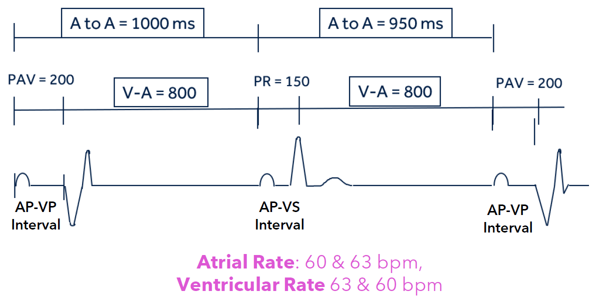 <p>the V-V interval remains constant - <span>Focuses on the interval between two ventricular events (V-A interval).</span></p><p>This leads to an A-A interval less than 1,000 ms</p>