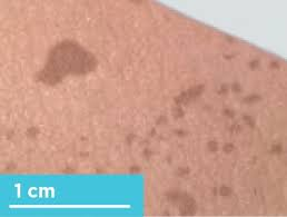 <p>A flat, distinct, and discolored area of skin that is usually less than one cm in diameter. </p><ul><li><p>A freckle is a macule.</p></li></ul><p></p>