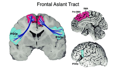 <p>frontal aslant tract </p>