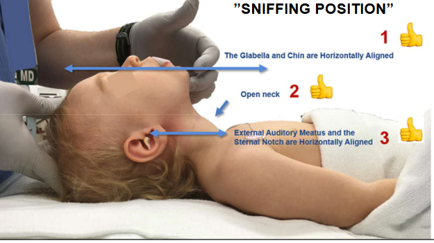 <p>Je beoordeelt hier de vitale functies (ABC) en de neurologische toestand (D). Direct levensbedreigende problemen die hier worden vastgelegd moeten meteen worden behandeld.</p><p>Je begint met de airway (A), de evaluatie van de bovenste luchtwegen:</p><p>-Is de luchtweg vrij en veilig?</p><p>-Is de luchtweg vrij maar bedreigd? Je kan de luchtweg als bedreigd beschouwen van zodra een kind zeer suf/bewusteloos is maar wel nog ademt.</p><p>-Is er een partiële of volledige obstructie? Beschouw stridor of snurken als een partiële obstructie van de luchtweg.</p><p>=> Laat een kind dat bij bewustzijn is zelf de comfortabelste positie innemen.</p><p>Wanneer de luchtweg bedreigd of afgesloten is moet je deze vrijmaken:</p><ul><li><p>Tot 1 jaar neutrale positie</p></li><li><p>Vanaf 1 jaar sniffing position.</p></li><li><p>Jaw-thrust met het hoofd in neutrale stand bij kinderen met thoraxbeweging bij wie de head/chin-lift niet leidt tot een open bovenste luchtweg. Dit is ook de veiligste manier bij trauma.</p></li><li><p>+ Aspireren I.N en hulpmiddelen zoals nasofaryngeale canule.</p></li></ul><p>=> Voer bij kinderen geen blinde pogingen om de luchtwegobstructie met de vingers op te heffen uit. Het gehemelte kan hierdoor worden beschadigd met bloeding als gevolg, deze bloeding kan de obstructie verergeren. Een vreemd voorwerp kan ook verder worden opgeschoven wat verwijderen bemoeilijkt.</p><p>Je controleert de luchtweg met 3 observaties:</p><ol><li><p>Kijk → thoracale bewegingen?</p></li><li><p>Luister (AH-geluiden zoals stridor kunnen wijzen op partiële obstructie).</p></li><li><p>Voel → is er een luchtverplaatsing? Wanneer die er niet is moeten de luchtwegopenings manoeuvres opnieuw worden uitgevoerd en moet de doorgankelijkheid opnieuw worden beoordeeld.</p></li></ol><p>LET OP:</p><p>- Als het kind huilt of babbelt heeft het een open luchtweg, spontane AH, aanwezige circulatie en enige vorm van bewustzijn. Bij spontante AH kan inspiratoire stridor en intrekkingen van de borstkas wijzen op een bovenste luchtwegobstructie.</p><p>-Obstructie is bij kinderen de primaire oorzaak van een cardiorespiratoire stilstand.</p><p>-Wanneer een kind bewusteloos is moet je nakijken of de tong de luchtweg niet blokkeert.</p><p>-Hou er ook mee dan kinderen onder de 6m obligate neusademhalers zijn. Zuigelingen en kinderen hebben ook andere anatomische en fysiologische kenmerken.</p>