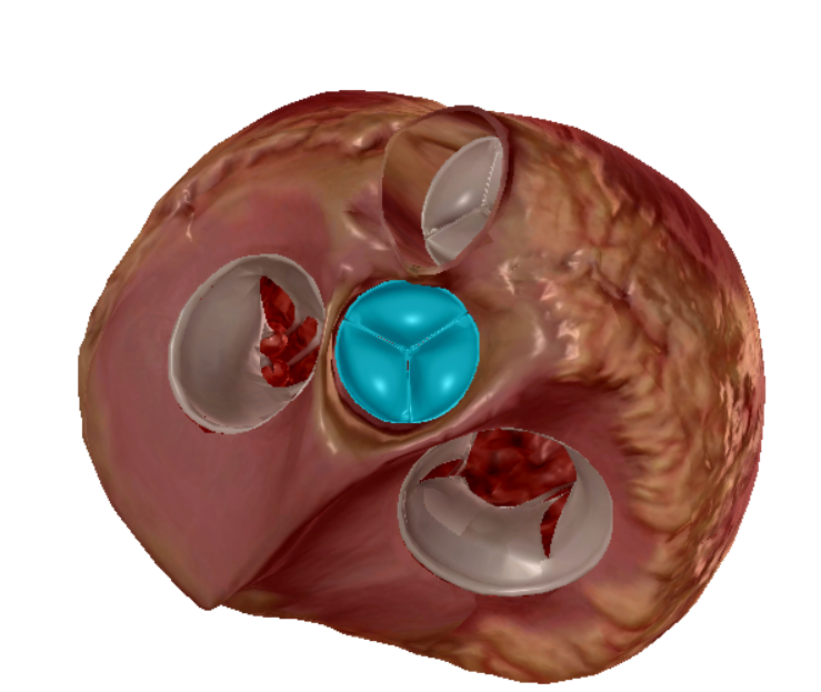 <p>left ventricle to aorta</p>