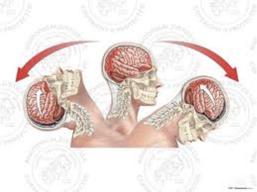 <p>severe traumatic brain injury involving contusions at both sides</p>
