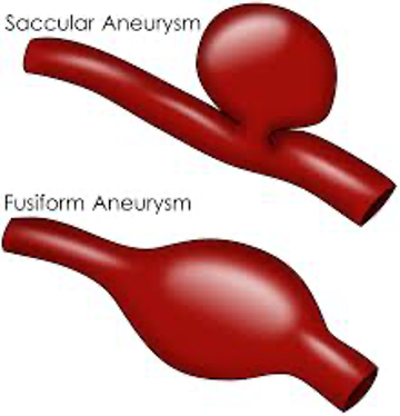 <ul><li><p>localized weakening and thinning of an arterial wall » causing dilatation of all 3 layers</p></li><li><p>may rupture into IVC » causinf massive A-V fistula OR rupture into duodenum w upper GI bleeding (RARE)</p></li><li><p>males>females</p></li><li><p>most found inferior to renal arteries</p></li><li><p>commonly associated w:</p><ul><li><p>iliac, femoral, and popliteal aneurysms</p></li></ul></li><li><p>ectatic: mild enlargement of aorta</p></li><li><p>cigarette smoking is a risk factor</p></li></ul><p><strong>parameters:</strong></p><ul><li><p>~1.5x normal caliber (compared to adj. segment) is considered aneurysmal or >/= 2cm (outer-outer wall)</p></li></ul><p><strong>two AAA types:</strong></p><p>FUSIFORM</p><ul><li><p>most common</p></li><li><p>usually infrarenal</p></li><li><p>all 3 layers bulge out symmetrically</p></li><li><p>may contain thrombus</p></li></ul><p>SACCULAR</p><ul><li><p>focal outpouching/asymmetric dilatation</p></li><li><p>rare, least common</p></li><li><p>assoc. w/ infection</p></li></ul><p><strong>treatment:</strong></p><ul><li><p>recommended once 5-5.5cm diameter reached</p></li><li><p>treatment is imperative at 6cm » risk for rupture inc. </p></li></ul><p><strong>sono findings:</strong></p><ul><li><p>possibly turbulent color dopp flow within aneurysm</p></li><li><p>dec. velocities and may show lower resist.</p></li></ul><p></p>