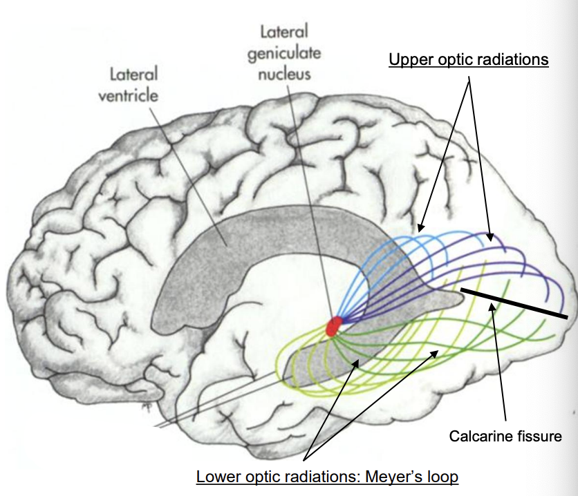 <ul><li><p>info from LGN reaches primary visual cortex via Optic radiations </p></li><li><p>upper optic radiations </p><ul><li><p>process lower visual field info from each eye </p></li><li><p>travel through parietal lobe then synapse in cuneus gyrus of primary visual cortex (occipital lobe) </p></li></ul></li><li><p>lower optic radiations (Meyer’s loop) </p><ul><li><p>process upper visual field info from each eye </p></li><li><p>travel through temporal lobe then synapses in lingual gyrus of the primary visual cortex (occipital lobe) </p></li></ul></li></ul><p></p>