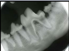 <p>What is this x ray indicative of?</p>