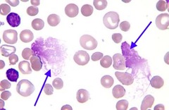 <p>a ruptured leukocyte, seen in chronic lymphocytic leukemia</p>