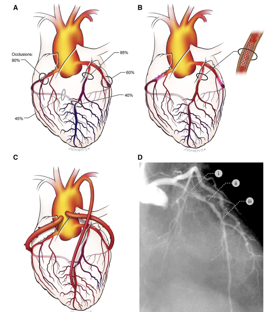 <p>Name this process. used to restore healthy blood flow to the heart muscle when coronary arteries become blocked or narrowed</p>