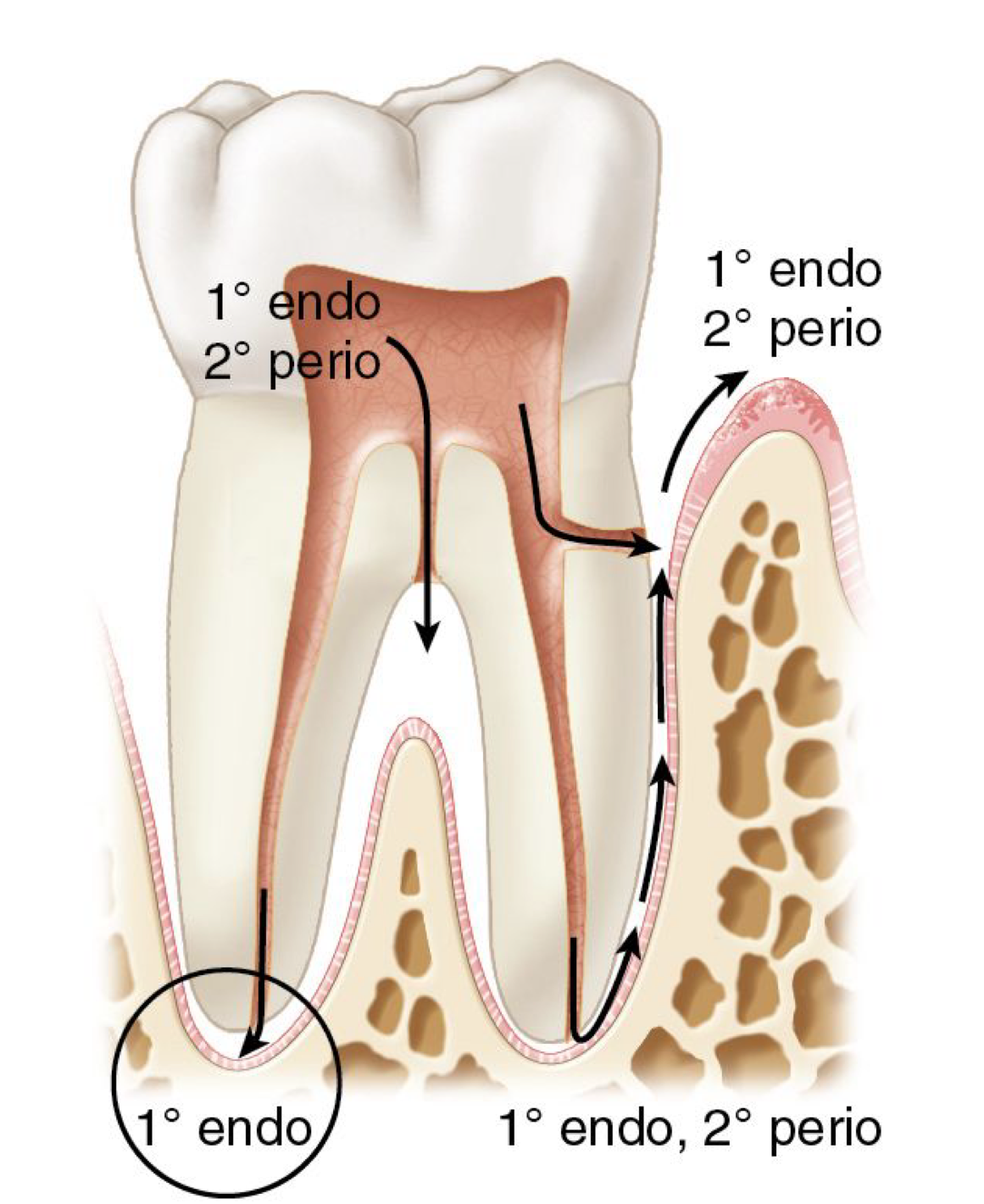 <p>What type of lesion?</p><p>An endodontic problem originating from the pulp space, traveling through the apical foramen or accessory canals into the periodontium</p>
