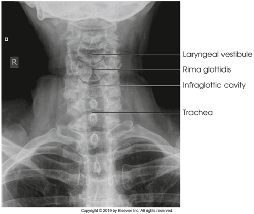 <p>Erect, raised chin. Center at T1-2, 1 inch above jugular notch. SID 40” 75-85 kV, 100mA, 0.10-0.12 sec, 10-12 mAs. Slow, deep inspirations</p>